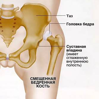 Врожденный вывих бедра