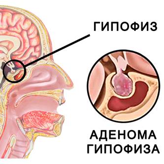 Аденома гипофиза